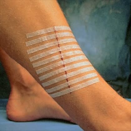 Sutur tape Steri-Strip 3x75mm 5 stk